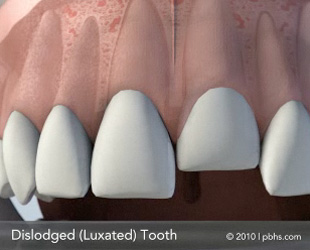 Dislodged Tooth